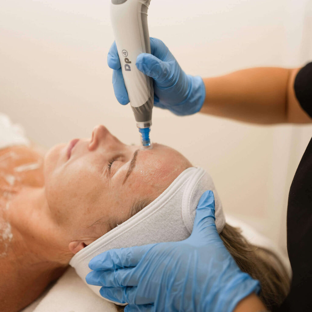 microneedling in Vancouver BC