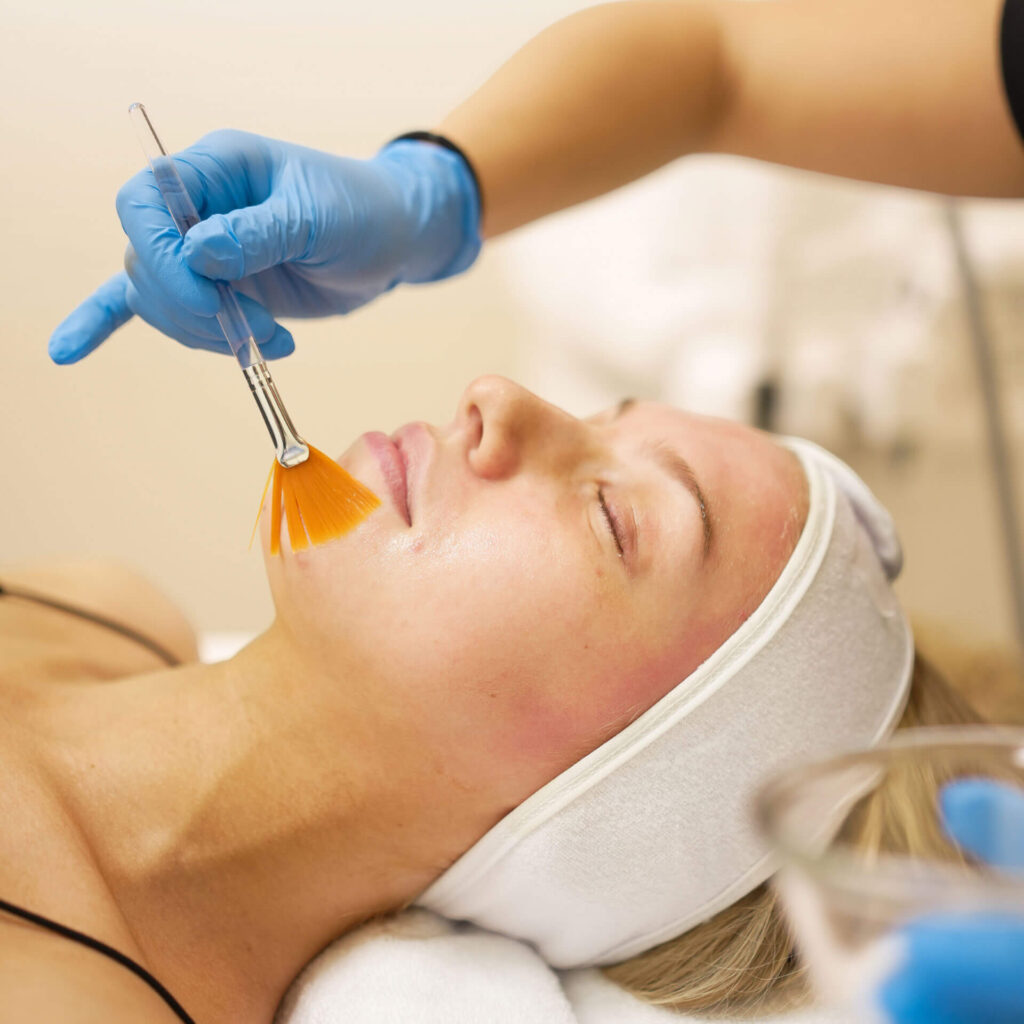 ZO stimulator peel and facials in Vancouver BC