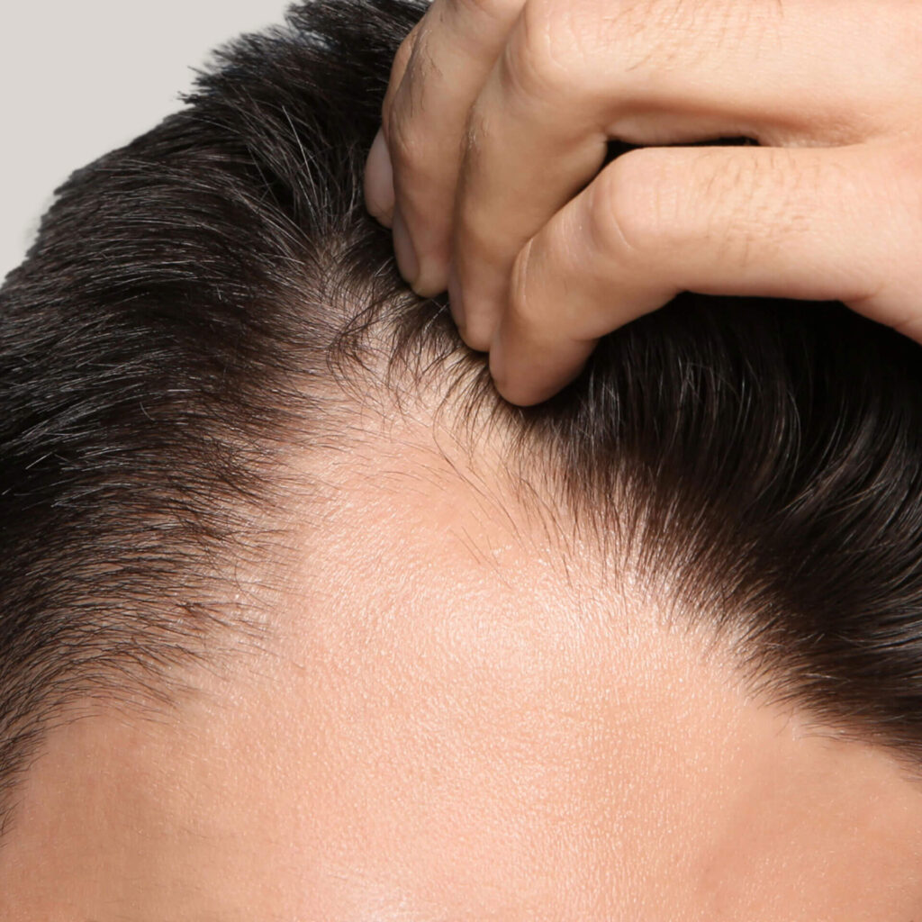 Hair loss treatment in Vancouver BC