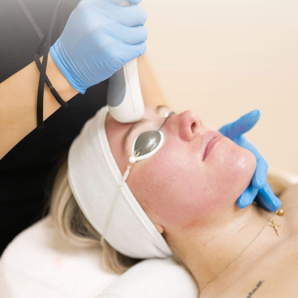 Intense Pulsed Light Therapy Vancouver BC