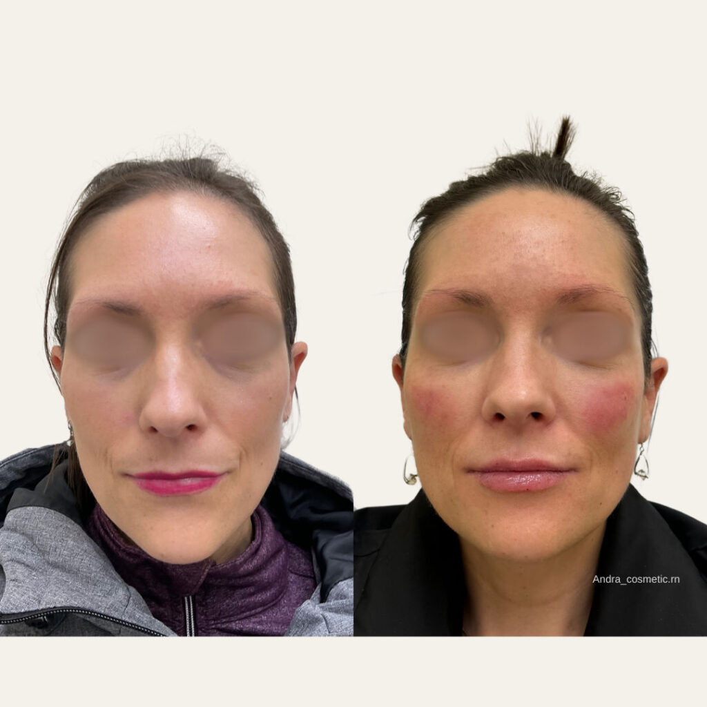 Sculptra treatment